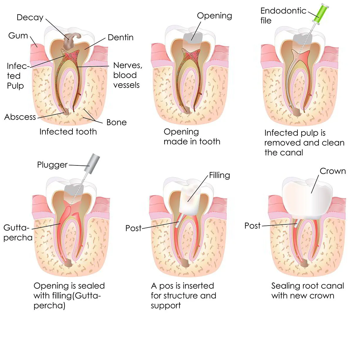 root canal in Lotus Dental 
