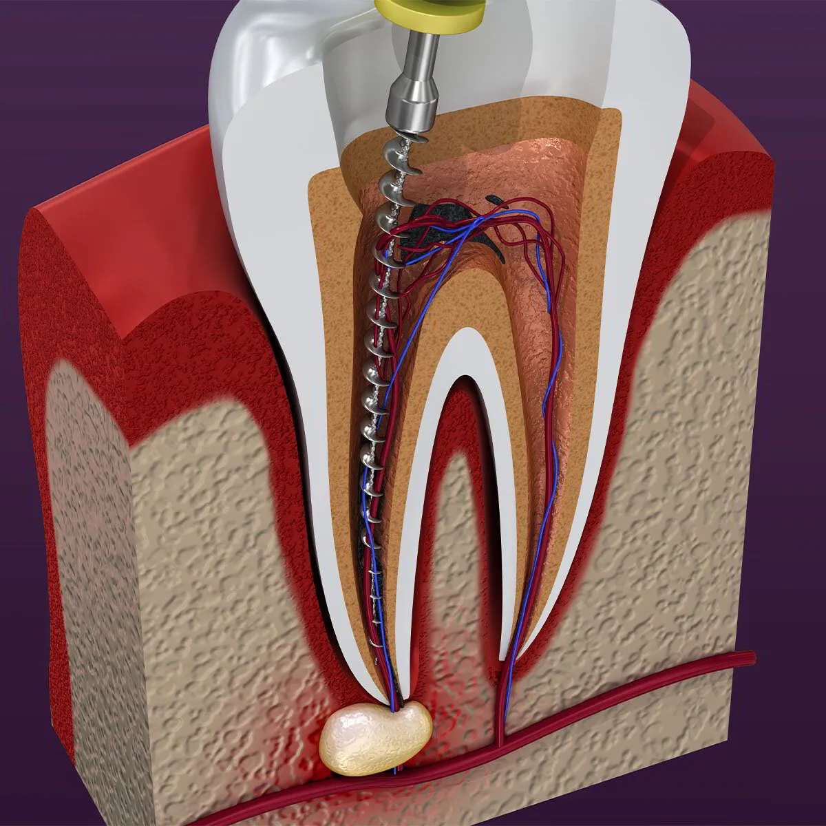 Healing of root canal treatment in Lotus Dental