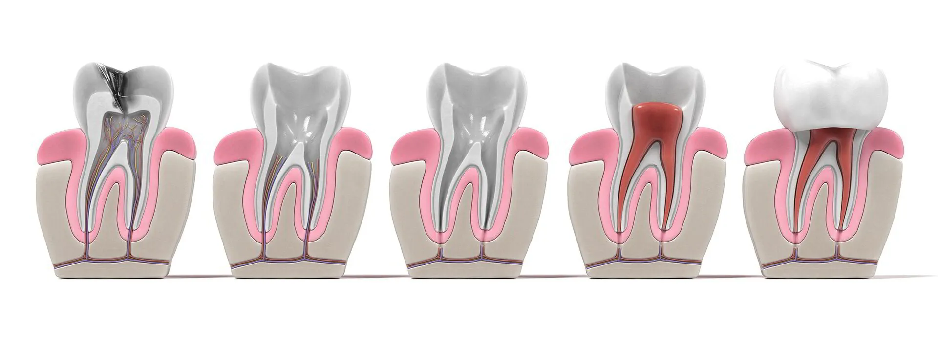 process of root canal treatment teeth in Lotus Dental