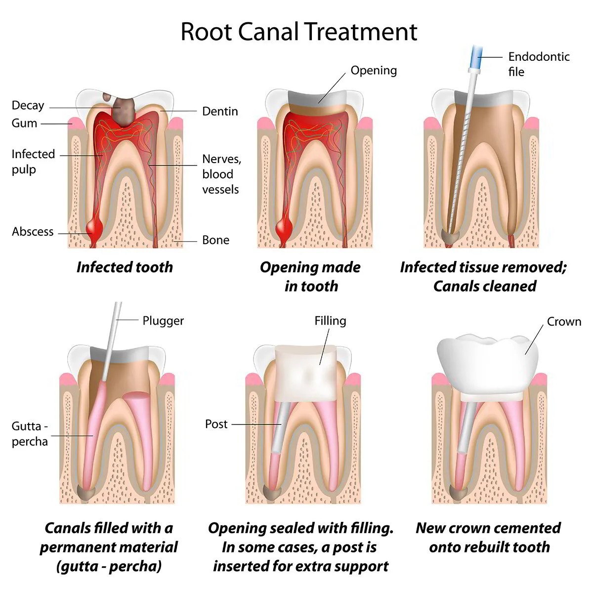 root canal and crown treatment 