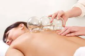 Cupping treatment at Harefield Acupuncture Wantage Oxfordshire