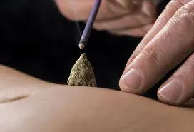 Moxa treatment at Harefield Acupuncture Wantage Oxfordshire