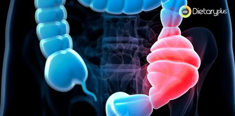 Nutricionista Zaragoza  - 3 factores que provocan Estreñimiento