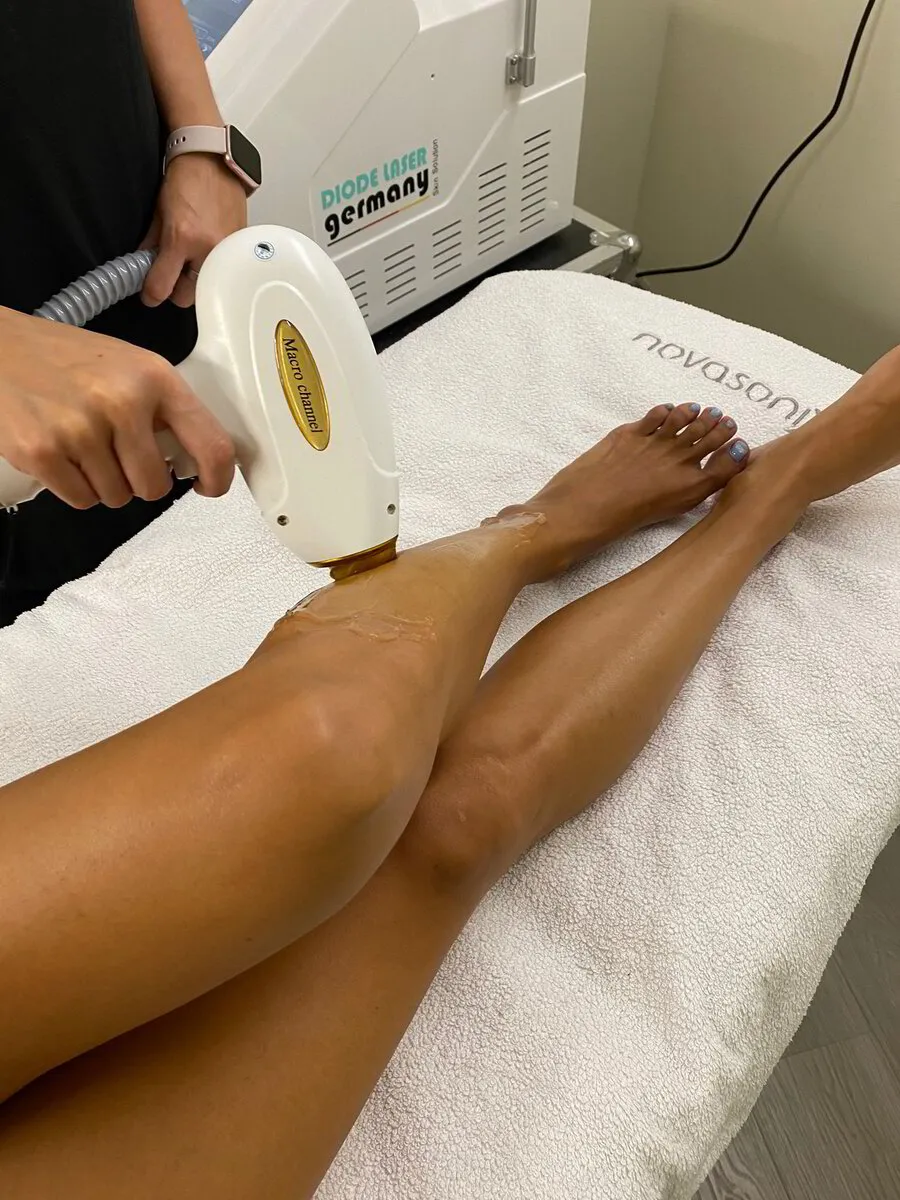 Láser Diodo Depilacion Laser Que Se Puede Tomar El Sol Láser