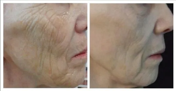 Skin Needling Before & After