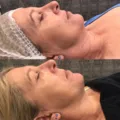 RF Skin Tightening - Face & Neck - Package of three (save 20%)