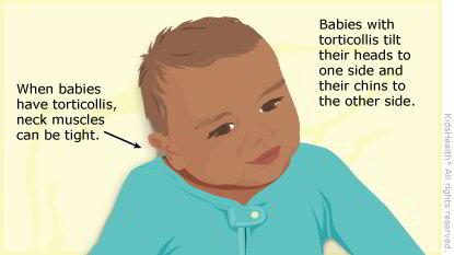 What Is Torticollis A EnIL 4087585 