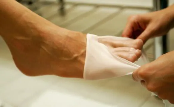 Podiatry remove Paraffin Wax from the patient's foot during  treatment