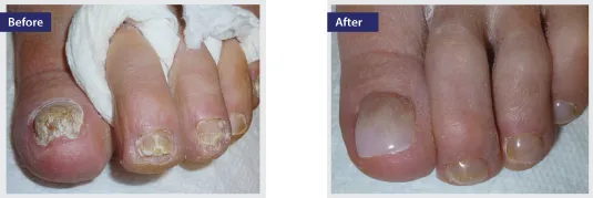 Before and after using KeryFlex Nail Restoration Cream