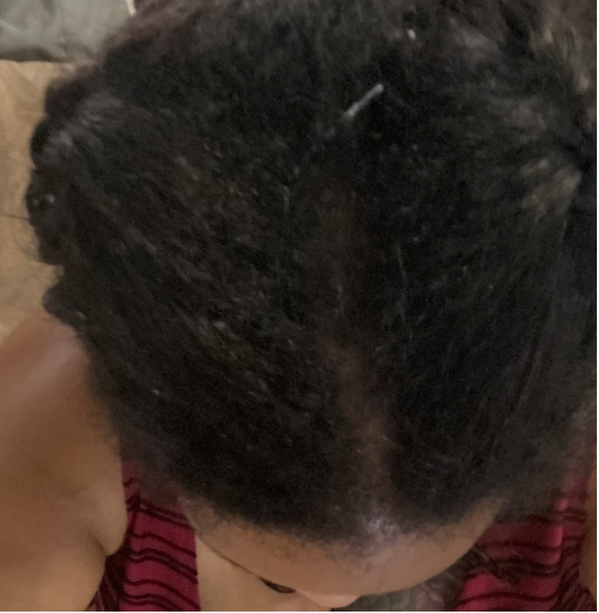 The Sprouter | Hair Growth & Alopecia Reversal