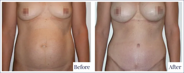 Before & After Tummy Tuck Surgery