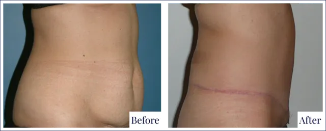 Before & After Tummy Tuck Cosmetic Surgery
