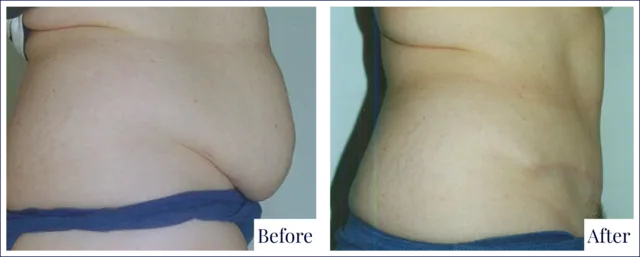 Before & After Tummy Tuck Treatment