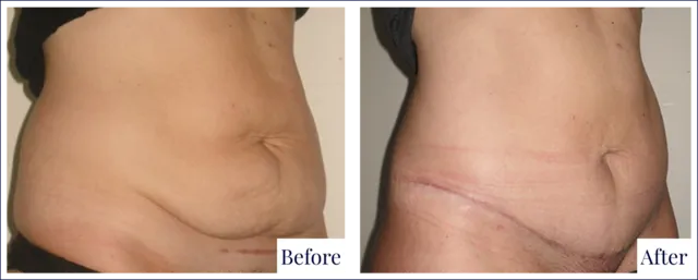 Before & After Tummy Tuck Procedures