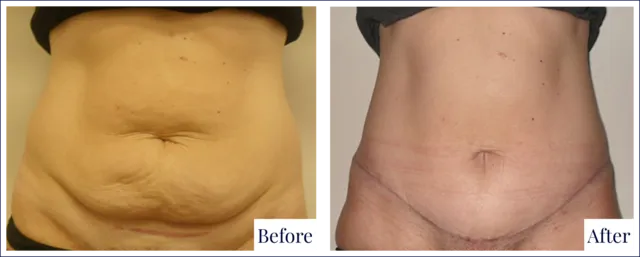 Tummy Tuck Cosmetic Surgery Before and After Image