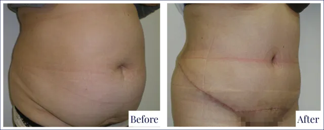 Before & After Tummy Tuck Plastic Surgery