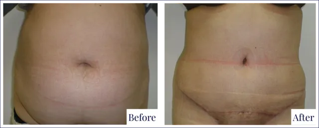 Before & After Abdominoplasty Surgery
