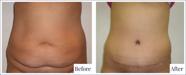 Tummy Tuck Surgery Before & After Image