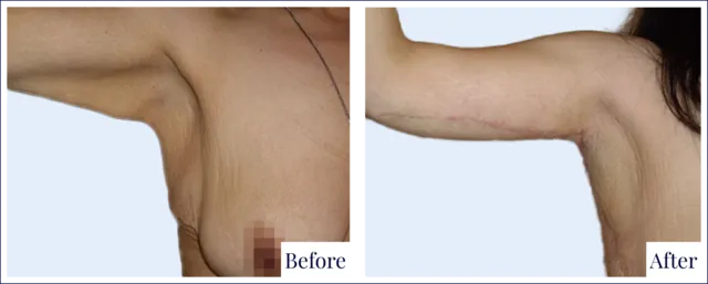 Brachioplasty Surgery Before and After Photo