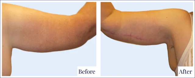 Brachioplasty Before and After Photo