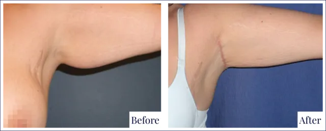Arm Reduction Before and After Photo
