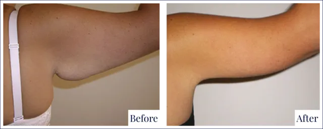 Arm Reduction Before and After Image