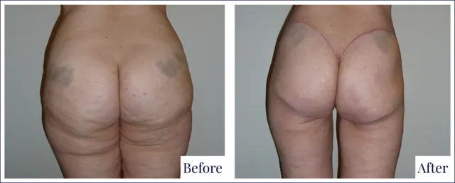 Body Lift Surgery Result