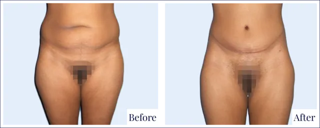 Body Lift Cosmetic Surgery Result