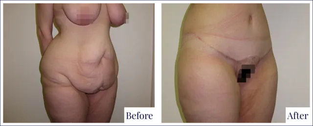 Body Lift Surgery Before & After Photo