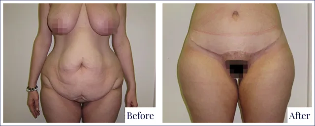 Body Lift Surgery Before & After Image