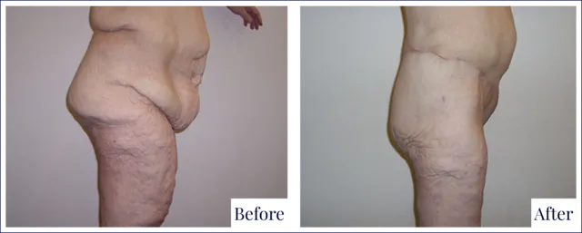 Body Procedure Before & After Photo