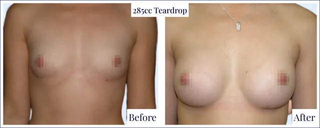 Breast Implant Before & After Photo