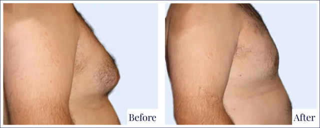 Male Breast Surgery Gallery