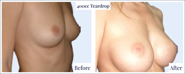 Breast Enlargement Before & After Photo