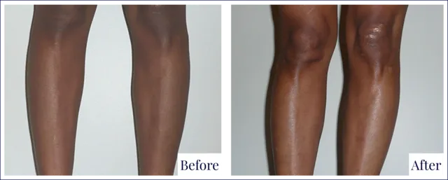 Calf Implant Before & After Photo