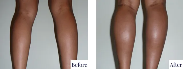 Calf Implant Before & After Image