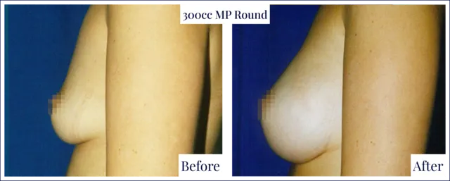 Breast Enlargement Before & After Image