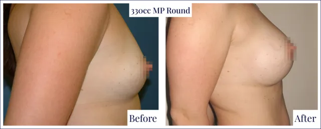 Breast Implant Before & After Image