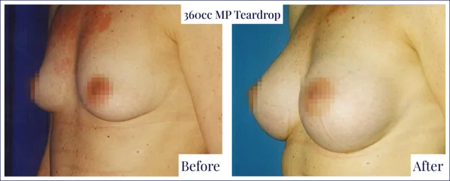Breast Enlargement Result