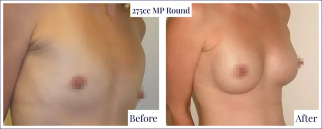 Breast Implant Result