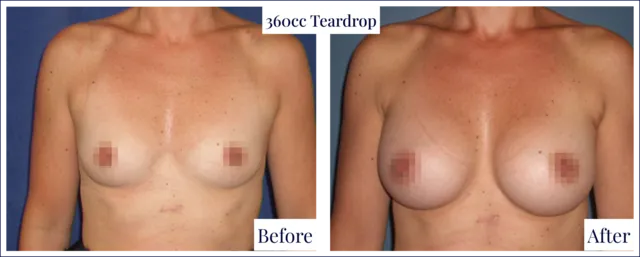 Breast Augmentation Result