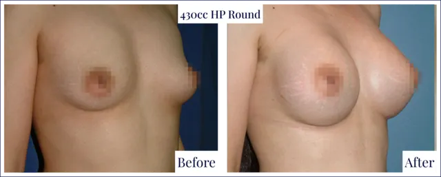 Breast Enlargement Before & After Photo