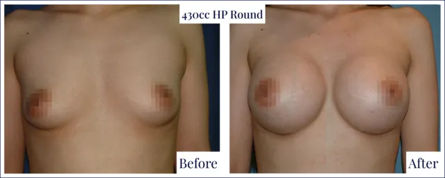 Breast Implant Before & After Image