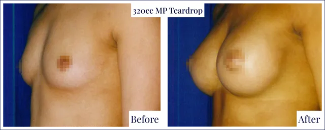 Breast Enlargement Before & After Image