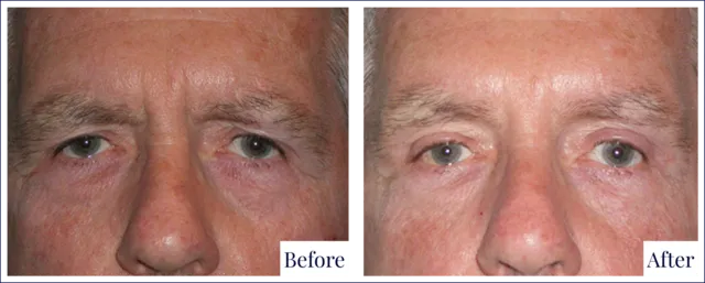 Eyelid Surgery Before & After Photo