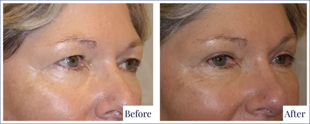 Eyelid Surgery Before & After Photo