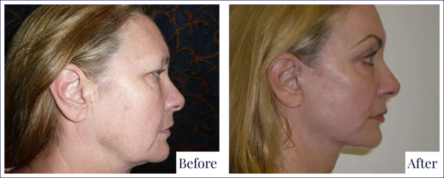 Facial Lift Before & After Image
