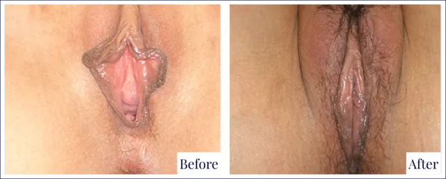 Genital Surgery Before & After Photo