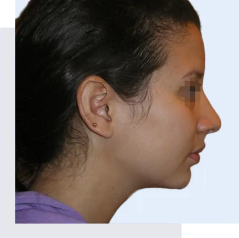 Face Surgery Gallery