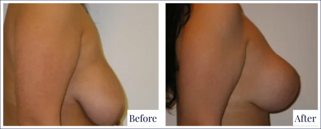 Breast Lift Before & After Result